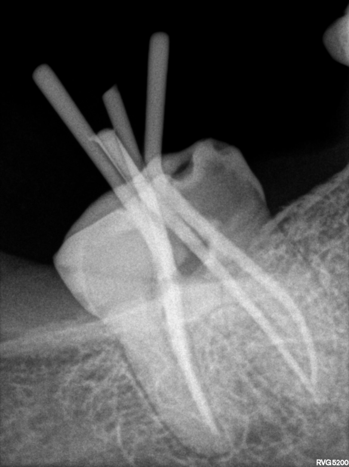Dental X-ray